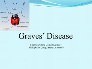 Graves’ Disease
Cherry Kristine Gomez Lavador
Biologist of Caraga State University

 