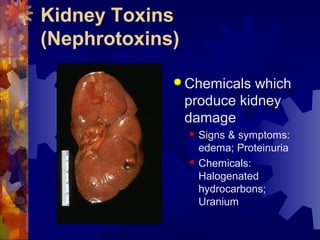 Kidney Toxins
(Nephrotoxins)
 Chemicals which
produce kidney
damage
 Signs & symptoms:
edema; Proteinuria
 Chemicals:
Halogenated
hydrocarbons;
Uranium
 