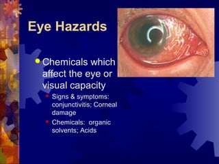 Eye Hazards
 Chemicals which
affect the eye or
visual capacity
 Signs & symptoms:
conjunctivitis; Corneal
damage
 Chemicals: organic
solvents; Acids
 