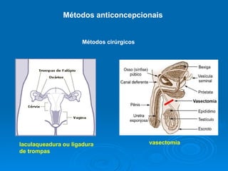 Métodos anticoncepcionais  laculaqueadura ou ligadura de trompas Métodos cirúrgicos vasectomia  