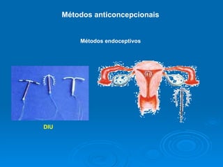 Métodos anticoncepcionais  Métodos endoceptivos DIU  