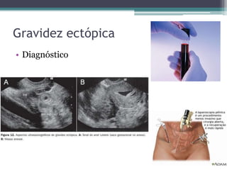 Gravidez ectópica 
• Diagnóstico 
 