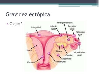 Gravidez ectópica 
• O que é 
 