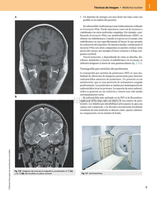©Elsevier.Fotocopiarsinautorizaciónesundelito.
Técnicas de imagen • Medicina nuclear 1
A
Fig. 1.10 Imágenes de resonancia magnética, ponderadas en TI (A)
y en T2 (B), del encéfalo en plano coronal.
■ Un depósito de energía con una dosis tan baja como sea
posible en los tejidos del paciente.
Elradionúclido (radioisótopo) más habitualmente utilizado
es el tecnecio 99m. Puede inyectarse como sal de tecnecio o
combinado con otras moléculas complejas. Por ejemplo, com­
binando el tecnecio 99m con metilendifosfonato (MDF), se
obtiene un radiofármaco. Cuando se inyecta en el cuerpo, este
radiofármaco se une específicamente al hueso, lo que permite
la evaluación del esqueleto. Demanera similar, combinando el
tecnecio 99m con otros compuestos se pueden evaluar otras
partes del cuerpo, por ejemplo el tracto urinario y el flujo san­
guíneo cerebral.
Tras la inyección, y dependiendo de cómo se absorba, dis­
tribuya, metabolice y excrete el radiofármaco en el cuerpo, se
obtienen imágenes a través de una gammacámara (fig. 1.11).
Tomografía por emisión de positrones
La tomografía por emisión de positrones (PET) es una mo­
dalidad de obtención de imágenes proyectada para detectar
radionúclidos emisores de positrones. Un positrón es un
antielectrón, que es una partícula de antimateria cargada
positivamente. Los positrones se emiten por desintegración de
radionúclidos ricos en protones. La mayoría de estos radionú­
clidos se generan en un ciclotrón y tienen una vida media
extremadamente corta.
El radionúclido más utilizado en la PET es la fluorodeso-
xiglucosa (FDG) marcada con flúor 18 (un emisor de posi­
trones). Los tejidos que metabolizan activamente la glucosa
captan este compuesto, y la elevada concentración localizada
resultante de esta molécula se detecta como «punto caliente»
en comparación con la emisión de fondo.
Fig. 1.11 Gammacámara.
 