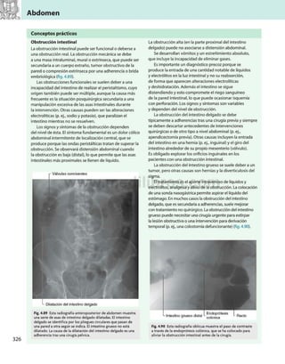 Abdomen
Conceptos prácticos
Obstrucción intestinal
La obstrucción intestinal puede ser funcional o deberse a
una obstrucción real. La obstrucción mecánica se debe
a una masa intraluminal, mural o extrínseca, que puede ser
secundaria a un cuerpo extraño, tumor obstructivo de la
pared o compresión extrínseca por una adherencia o brida
embriológica (fig. 4.89).
Las obstrucciones funcionales se suelen deber a una
incapacidad del intestino de realizar el peristaltismo, cuyo
origen también puede ser múltiple, aunque la causa más
frecuente es la situación posquirúrgica secundaria a una
manipulación excesiva de las asas intestinales durante
la intervención. Otras causas pueden ser las alteraciones
electrolíticas (p. ej., sodio y potasio), que paralizan el
intestino mientras no se resuelven.
Los signos y síntomas de la obstrucción dependen
del nivel de ésta. El síntoma fundamental es un dolor cólico
abdominal intermitente de localización central, que se
produce porque las ondas peristálticas tratan de superar la
obstrucción. Se observará distensión abdominal cuando
la obstrucción es baja (distal), lo que permite que las asas
intestinales más proximales se llenen de líquido.
r Válvulas conniventes
L Dilatación del intestino delgado
Fig. 4.89 Esta radiografía anteroposterior de abdomen muestra
una serie de asas de intestino delgado dilatadas. El intestino
delgado se identifica por los pliegues circulares que pasan de
una pared a otra según se indica. El intestino grueso no está
dilatado. La causa de la dilatación del intestino delgado es una
adherencia tras una cirugía pélvica.
La obstrucción alta (en la parte proximal del intestino
delgado) puede no asociarse a distensión abdominal.
Se desarrollan vómitos y un estreñimiento absoluto,
que incluye la incapacidad de eliminar gases.
Es importante un diagnóstico precoz porque se
produce la entrada de una cantidad notable de líquidos
y electrólitos en la luz intestinal y no su reabsorción,
de forma que aparecen alteraciones electrolíticas
y deshidratación. Además el intestino se sigue
distendiendo y esto compromete el riego sanguíneo
de la pared intestinal, lo que puede ocasionar isquemia
con perforación. Los signos y síntomas son variables
y dependen del nivel de obstrucción.
La obstrucción del intestino delgado se debe
típicamente a adherencias tras una cirugía previa y siempre
se deben descartar antecedentes de intervenciones
quirúrgicas o de otro tipo a nivel abdominal (p. ej.,
apendicectomía previa). Otras causas incluyen la entrada
del intestino en una hernia (p. ej., inguinal) y el giro del
intestino alrededor de su propio mesenterio (vólvulo).
Es obligado explorar los orificios inguinales en los
pacientes con una obstrucción intestinal.
La obstrucción del intestino grueso se suele deber a un
tumor, pero otras causas son hernias y la diverticulosis del
sigma.
El tratamiento es el aporte intravenoso de líquidos y
electrólitos, analgesia y alivio de la obstrucción. La colocación
de una sonda nasogástrica permite aspirar el líquido del
estómago. En muchos casos la obstrucción del intestino
delgado, que es secundaria a adherencias, suele mejorar
con tratamiento no quirúrgico. La obstrucción del intestino
grueso puede necesitar una cirugía urgente para extirpar
la lesión obstructiva o una intervención para derivación
temporal (p. ej., una colostomía defuncionante) (fig. 4.90).
Fig. 4.90 Esta radiografía oblicua muestra el paso de contraste
a través de la endoprótesis colónica, que se ha colocado para
aliviar la obstrucción intestinal antes de la cirugía.
 