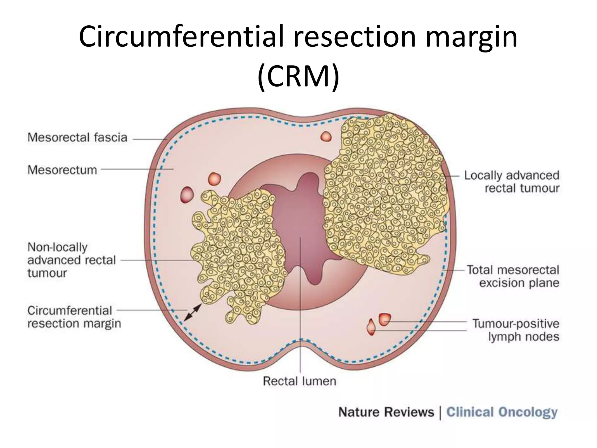 Gray areas in the management of colorectal cancer | PPTX