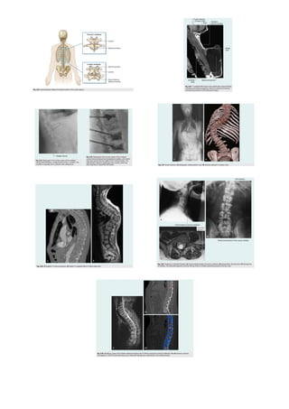 Gray's Anatomy, Chapter 2, Skeletal Framework Of The Back | PDF