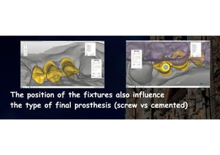 The position of the fixtures also influence
the type of final prosthesis (screw vs cemented)