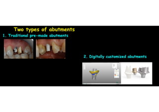 Two types of abutments
1. Traditional pre-made abutments
!
!
!
2. Digitally customized abutments
!
!
!