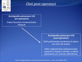 Dati post-operatori
Corso di Aggiornamento sull’Ipertensione Polmonare – Pavia, 14/15 Aprile 2015
Scintigrafia polmonare V/Q
pre-operatoria
Estesi fenomeni tromboembolici
bilaterali
Scintigrafia polmonare V/Q
post-operatoria
Shift perfusionale al polmone di destra
con furto dal sinistro
Netto miglioramento perfusione lobo
superiore e lingula a sinistra, a destra
riperfusione più marcato dall’inferiore.
 
