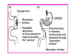 Gastro Retentive Drug Delivery System
