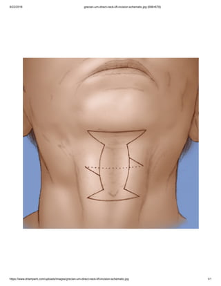 8/22/2018 grecian-urn-direct-neck-lift-incision-schematic.jpg (698×678)
https://www.drlamperti.com/uploads/images/grecian-urn-direct-neck-lift-incision-schematic.jpg 1/1
 