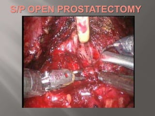 MRI ΠΥΕΛΟΥΜΟΡΦΩΜΑ 8Χ7Χ5cm, ΟΠΙΣΘΟΚΥΣΤΙΚΑ,ΠΟΛΥΧΩΡΟ,ΚΥΣΤΙΚΟΥ ΧΑΡΑΚΤΗΡΑ, ΣΑΦΩΣ ΑΦΟΡΙΖΟΜΕΝΟ,ΜΗ ΔΙΗΘΗΤΙΚΟ,ΠΙΘΑΝΩΣ ΕΞΟΡΜΩΜΕΝΟ ΑΠΟ ΤΟ ΔΕΞΙΟ ΛΟΒΟ ΤΟΥ ΠΡΟΣΤΑΤΗ.