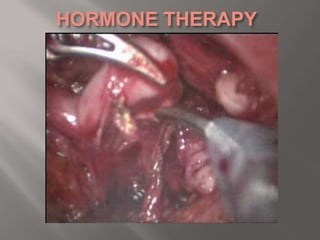 S/P OPEN PROSTATECTOMY