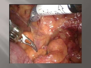        1  ΥΨΗΛΗ ΕΚΦΥΣΗ ΟΥΡΗΤΗΡΑΜΕΘΟΔΟΣ  :          ΤΟΠΟΘΕΤΗΣΗ DJ-STENT