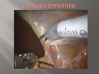 HYNES-ANDERSON ( DISMEMBERED)