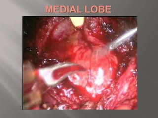 ΣΠΑΝΙΕΣ ΠΕΡΙΠΤΩΣΕΙΣΓΙΓΑΝΤΙΑΙΟ ΠΟΛΥΧΩΡΟ ΚΥΣΤΑΔΕΝΩΜΑ ΠΡΟΣΤΑΤΗΑΣΘΕΝΗΣ  47  ΕΤΩΝPSA=19ng/ml,ΔΥΣΟΥΡΙΚΑ ΕΝΟΧΛΗΜΑΤΑ-ΕΠΙΣΧΕΣΗ ΟΥΡΩΝΒΙΟΨΙΑ ΠΡΟΣΤΑΤΗ: ΚΑΛΟΗΘΗΣ ΥΠΕΡΤΡΟΦΙΑ ΠΡΟΣΤΑΤΗΚΥΣΤΕΟΣΚΟΠΗΣΗ: ΜΟΡΦΩΜΑ ΠΡΟΣΤΑΤΙΚΗΣ ΜΟΙΡΑΣ ΟΥΡΗΘΡΑΣΡΟΜΠΟΤΙΚΗ ΡΙΖΙΚΗ ΠΡΟΣΤΑΤΕΚΤΟΜΗ