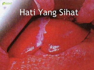 Hati Yang Sihat
 