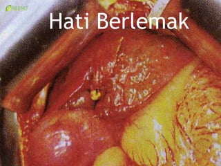 Hati Berlemak
 