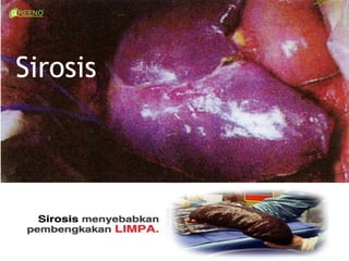 Sirosis
 