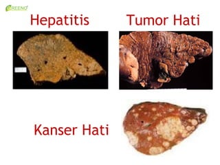 Hepatitis     Tumor Hati




Kanser Hati
 