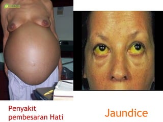 Penyakit
pembesaran Hati   Jaundice
 
