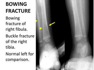 greenstick-fractures-pptx