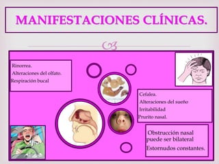 
Rinorrea.
Alteraciones del olfato.
Respiración bucal
Obstrucción nasal
puede ser bilateral
Estornudos constantes.
Cefalea.
Alteraciones del sueño
Irritabilidad
Prurito nasal.
MANIFESTACIONES CLÍNICAS.
 