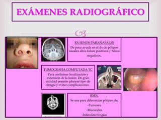 
EXÁMENES RADIOGRÁFICO
RX SENOS PARANASALES
De poca ayuda en el dx de pólipos
nasales altos falsos positivos y falsos
negativos.
TUMOGRAFIA COMPUTADA TC
Para confirmar localización y
extensión de la lesión. De gran
utilidad permite planear tipo de
cirugía y evitar complicaciones .
RMN.
Se usa para diferenciar pólipos de:
-Tumores
-Mucoceles
-Infección fúngica
 