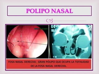 
POLIPO NASAL
 