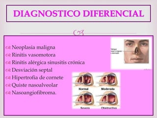 
DIAGNOSTICO DIFERENCIAL
 Neoplasia maligna
 Rinitis vasomotora
 Rinitis alérgica sinusitis crónica
 Desviación septal
 Hipertrofia de cornete
 Quiste nasoalveolar
 Nasoangiofibroma.
 