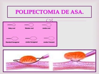 
POLIPECTOMIA DE ASA.
 
