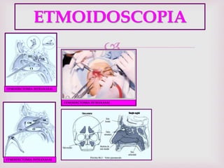 
ETMOIDOSCOPIA
ETMOIDECTOMIA INTRANASAL
ETMOIDECTOMIA INTRANASAL
ETMOIDECTOMIA INTRANASAL
 