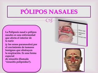 
PÓLIPOS NASALES
La Poliposis nasal o pólipos
nasales es una enfermedad
que afecta el interior de
la nariz
(y los senos paranasales) por
el crecimiento de tumores
benignos que obstruyen
la respiración. Es una forma
especial
de sinusitis (llamada
"sinusitis polipoidea").
 