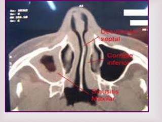 POLIPOS NASALES  GREISSI KELLI 