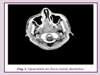 POLIPOS NASALES  GREISSI KELLI 
