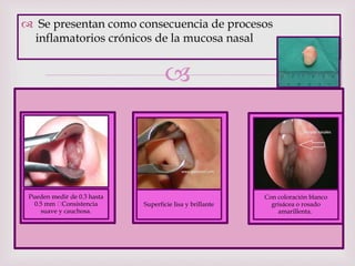 
Pueden medir de 0.3 hasta
0.5 mm Consistencia
suave y cauchosa.
Superficie lisa y brillante
Con coloración blanco
grisácea o rosado
amarillenta.
 Se presentan como consecuencia de procesos
inflamatorios crónicos de la mucosa nasal
 