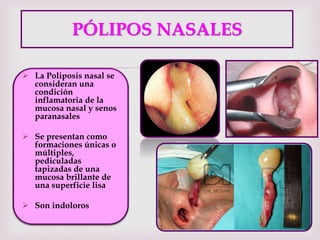 
PÓLIPOS NASALES
 La Poliposis nasal se
consideran una
condición
inflamatoria de la
mucosa nasal y senos
paranasales
 Se presentan como
formaciones únicas o
múltiples,
pediculadas
tapizadas de una
mucosa brillante de
una superficie lisa
 Son indoloros
 