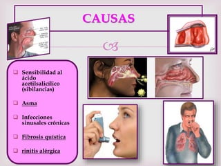 
CAUSAS
 Sensibilidad al
ácido
acetilsalicílico
(sibilancias)
 Asma
 Infecciones
sinusales crónicas
 Fibrosis quística
 rinitis alérgica
 