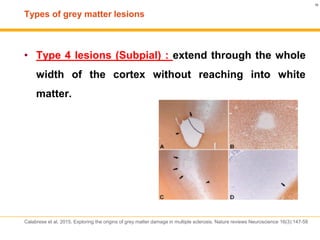 Grey matter and multiple sclerosis | PDF