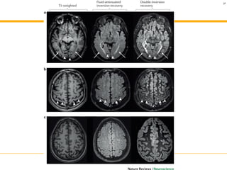 Grey matter and multiple sclerosis | PDF