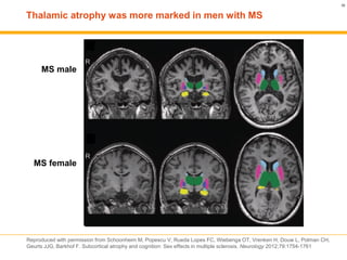 Grey matter and multiple sclerosis | PDF