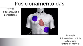 Direita
infraclavicular e
paraesternal
Posicionamento das
Pás
Esquerda
ápice cardíaco na linha
axilar média
evitando o mamilo
 