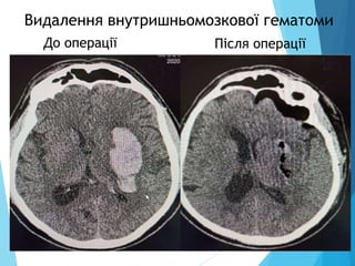 Після операції
До операції
Видалення внутришньомозкової гематоми
 