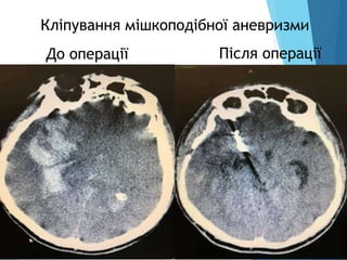 Кліпування мішкоподібної аневризми
Після операції
До операції
 