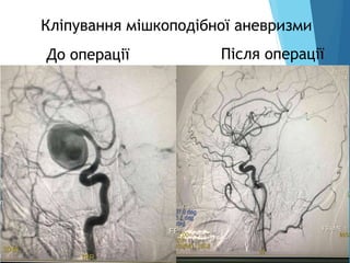 Кліпування мішкоподібної аневризми
Після операції
До операції
 
