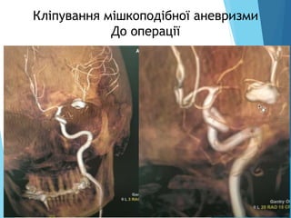 Кліпування мішкоподібної аневризми
До операції
 