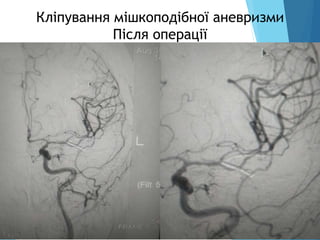 Кліпування мішкоподібної аневризми
Після операції
 