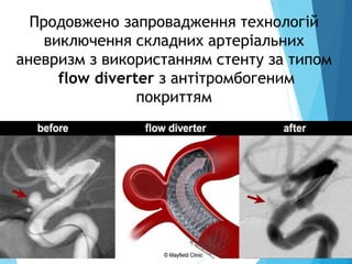 Продовжено запровадження технологій
виключення складних артеріальних
аневризм з використанням стенту за типом
flow diverter з антітромбогеним
покриттям
 