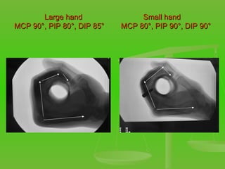 Large hand  Small hand MCP 90 °, PIP 80°, DIP 85°  MCP 80°, PIP 90°, DIP 90° 